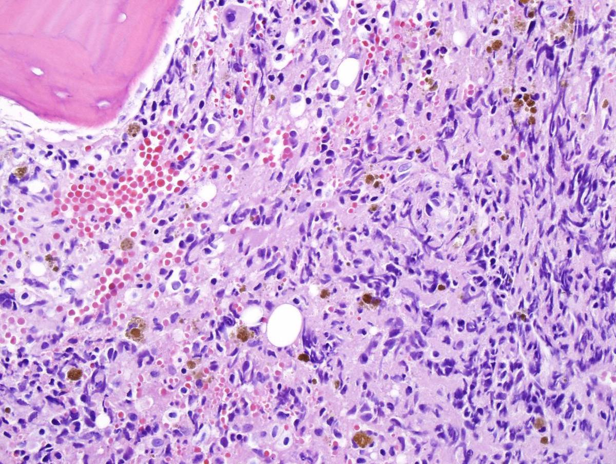 Second bone marrow core shows fibrosis.